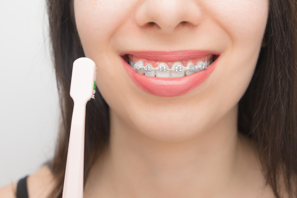 Clear Braces: A Discreet Way To Straighten Your Smile