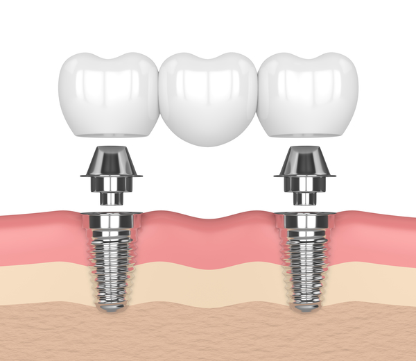 Dental Implants East Point, GA