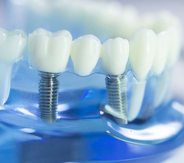 East Point The Dental Implant Procedure