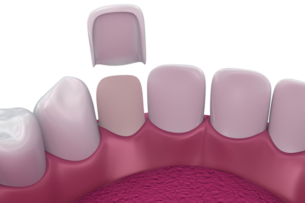 Are Veneers The Right Choice For Your Smile Goals?