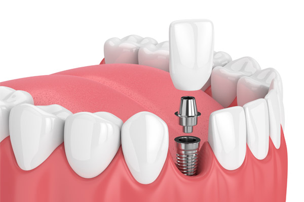 Prerequisites For Getting Dental Implants