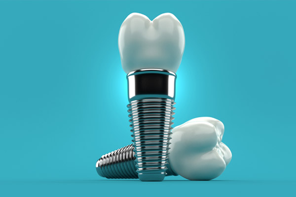 The FAQs Of Dental Implant Requirements
