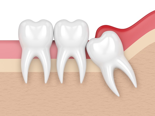 Reasons That Wisdom Tooth Extraction Is Needed